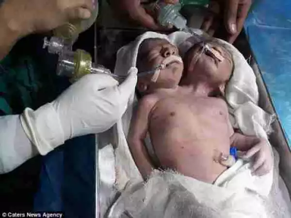 Photos: Twins Born with Two Heads Die After 24 Hours in India